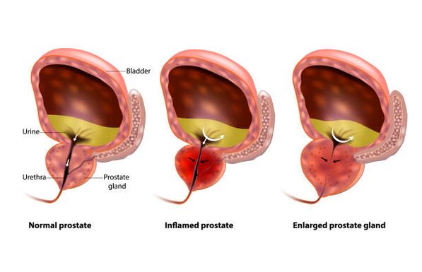 Prostatitis ass eng Entzündung vun der Prostatabdrüse